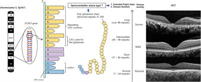 Ophthalmic Manifestations and Genetics of the Polyglutamine Autosomal Dominant Spinocerebellar Ataxias: A Review